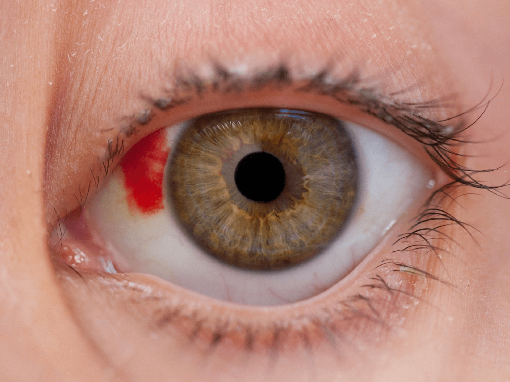 Trauma e Urgências Oculares